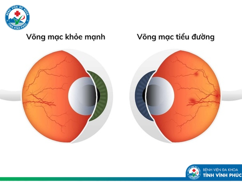 Mờ mắt vì tiểu đường – Đừng để mất thị lực chỉ vì đến bệnh viện quá muộn