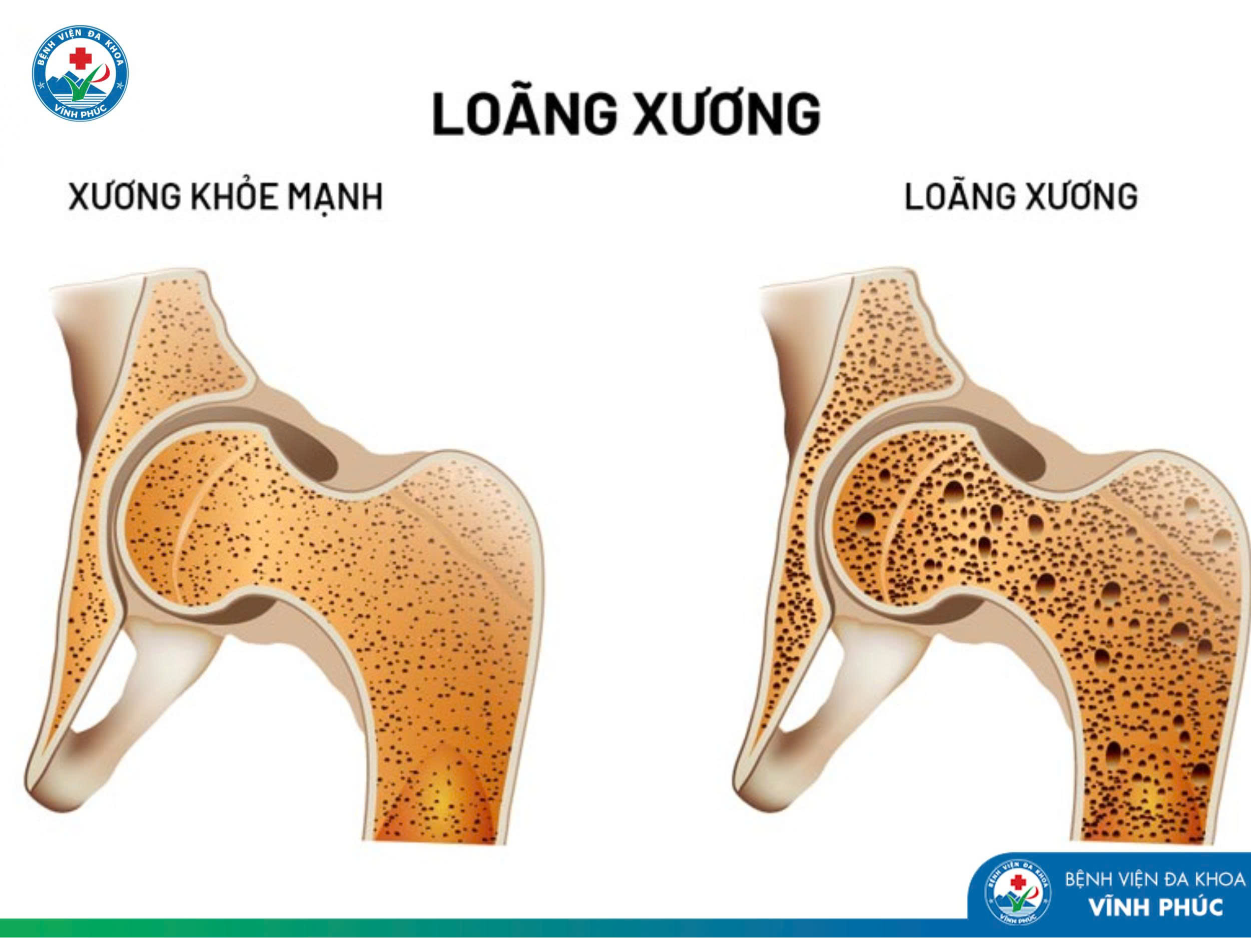 Loãng xương – Hệ lụy âm thầm từ việc sử dụng thuốc kéo dài, đặc biệt là corticoid