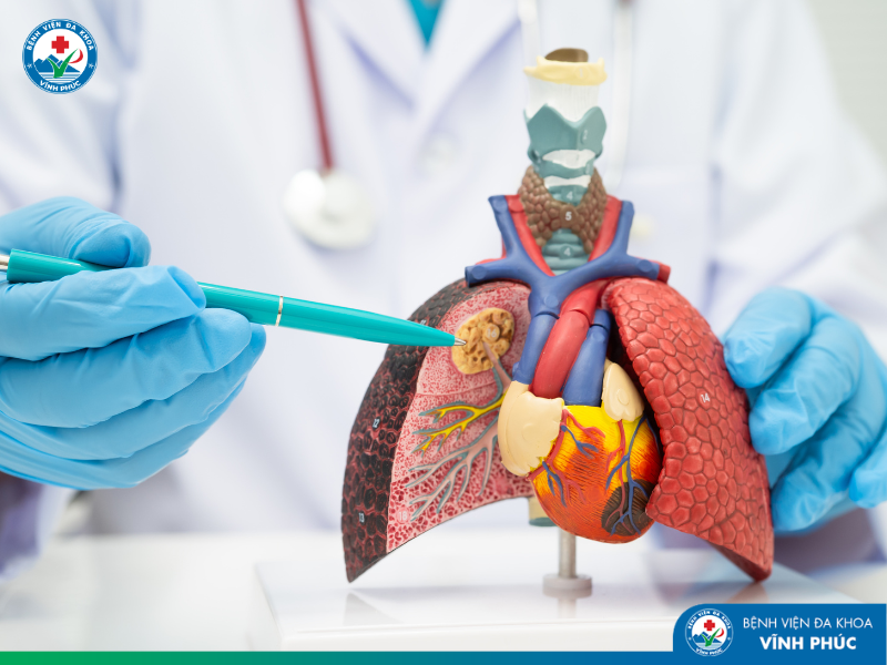 Viêm phổi mùa lạnh: dấu hiệu, nguy cơ và cách phòng tránh hiệu quả