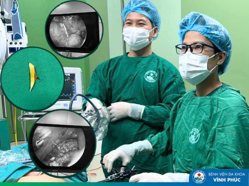 Cảnh báo nguy cơ thủng đường tiêu hóa do dị vật – biến chứng nguy hiểm có thể gặp ở mọi lứa tuổi