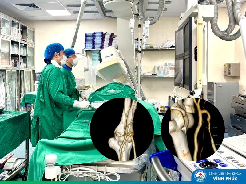 Triển khai kỹ thuật can thiệp nội mạch chuyên sâu: Khôi phục thành công đường truyền lọc máu cho người bệnh suy thận