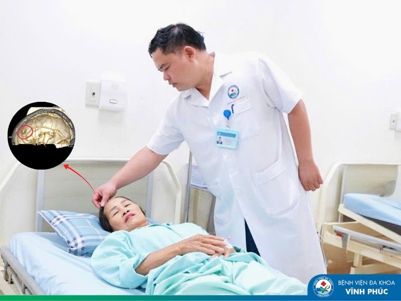 Phẫu thuật nội soi lấy thành công khối dị dạng thông động tĩnh mạch não -Bước tiến mới trong điều trị ngoại thần kinh